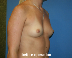 plastic-surgery-breast-augmentation